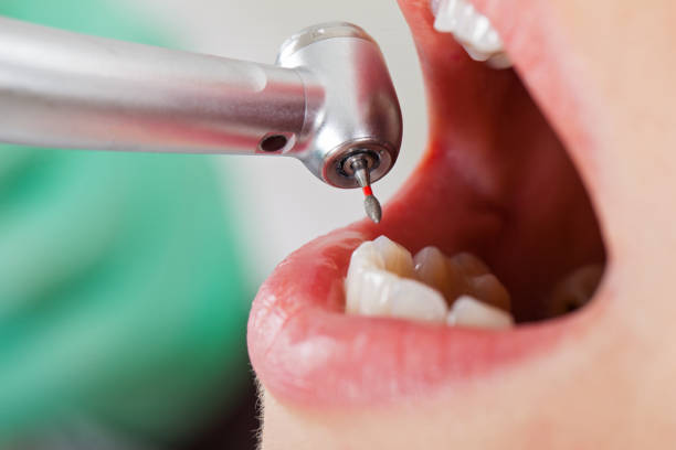 Best Emergency Wisdom Teeth Removal in Coachella, CA
